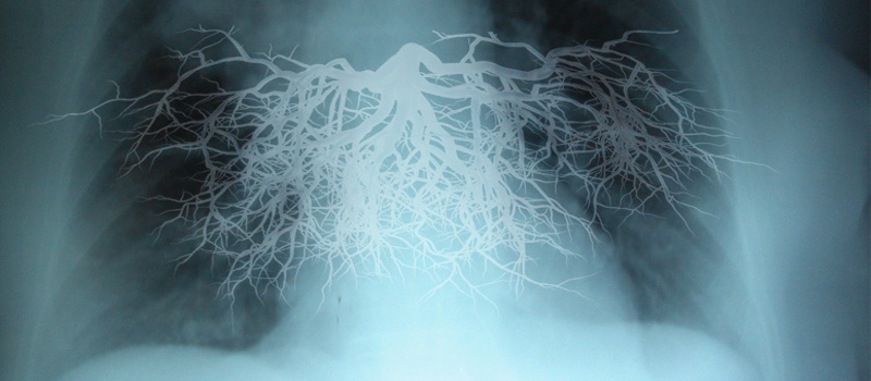 La canción "Respira conmigo" crea conciencia sobre la "Medicina de precisión" de la fibrosis quística